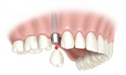 Best Tooth Replacement Options for Missing Teeth