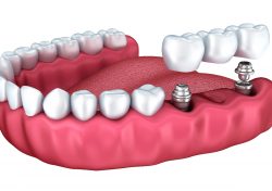 Full Mouth Implant Treatment