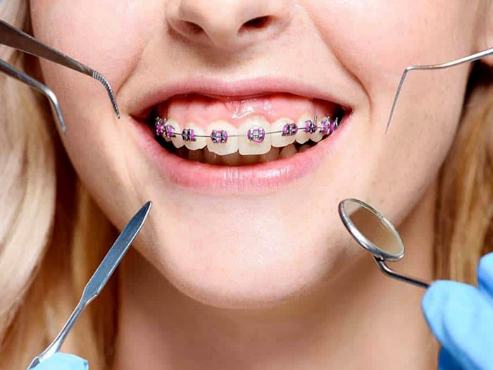 How Much Do Braces Cost?