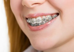 Orthodontic Treatment Options