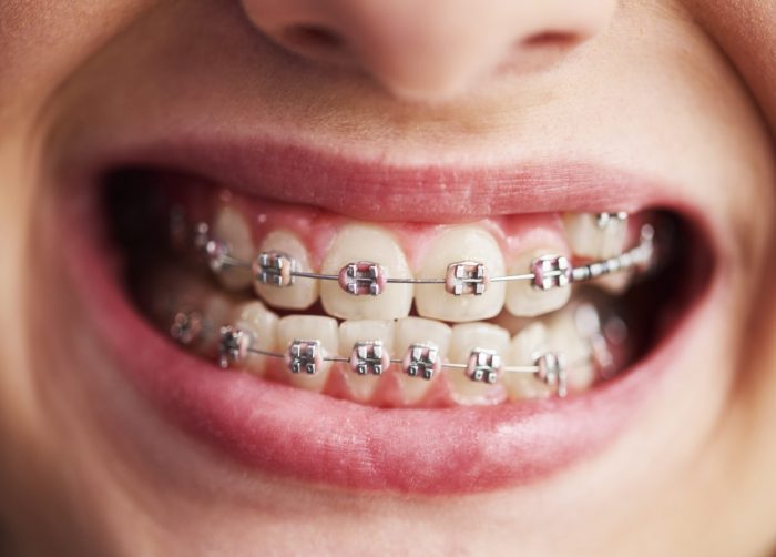 Find Local Braces Dentist