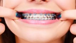 Best Orthodontist Near Me For Braces