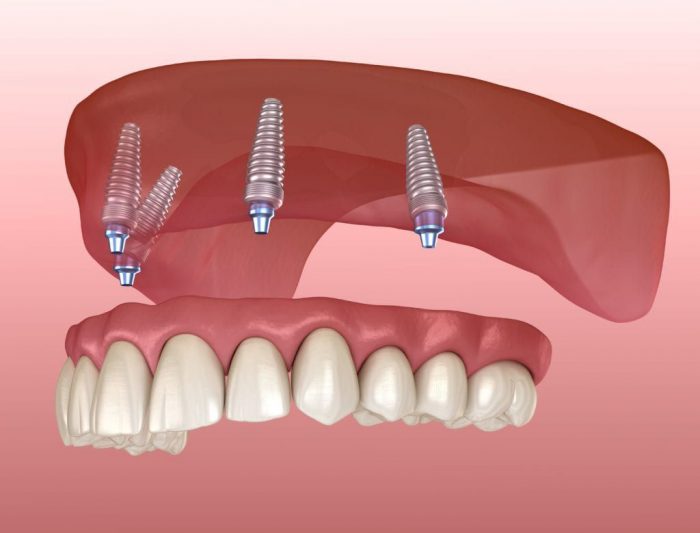 Same Day Dentures Before And After Process