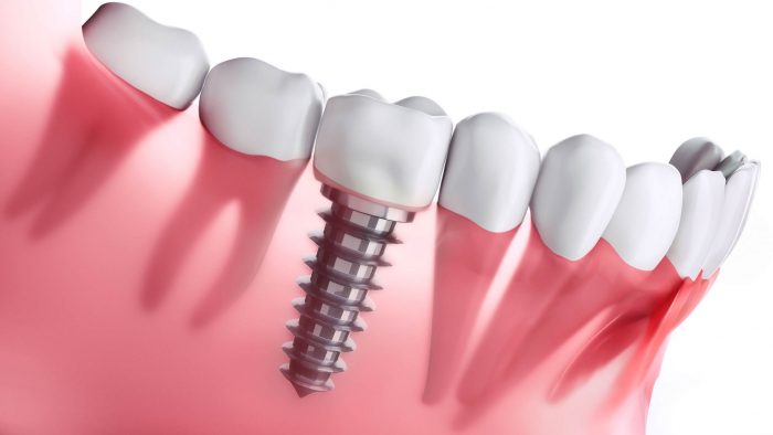 Dental Crowns Near Me in Houston