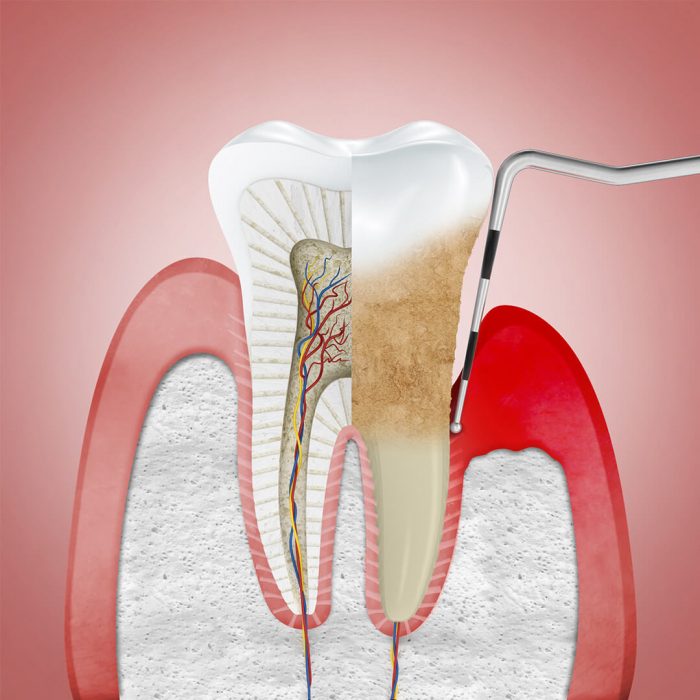 Stages of Periodontitis Symptoms