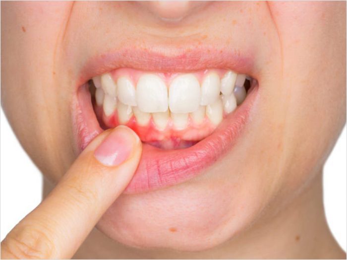 Symptoms of Periodontitis