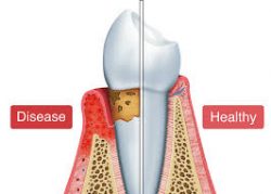 Periodontitis Treatments Houston