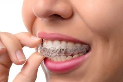 What to Look for in an Invisalign Dentist