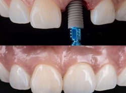 Single Tooth Dental Implants Houston, TX | Missing Teeth