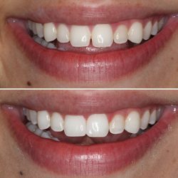 Types of dental crowns: which type is best for you