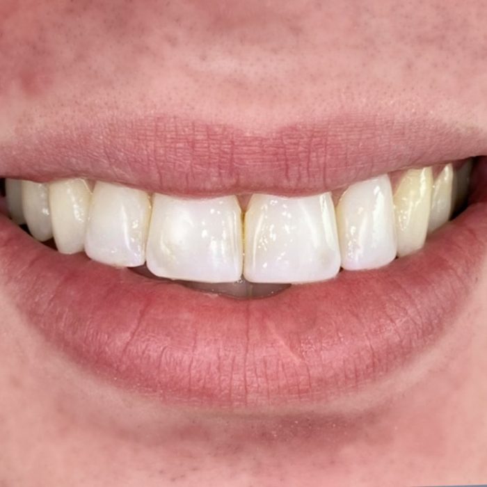 What’s the Best Type of Dental Crown Material?