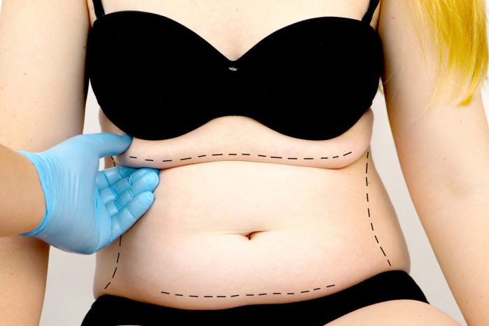 Tummy Tuck Before and After