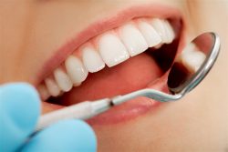 Teeth Gap Fillings Houston, TX – Best Dental