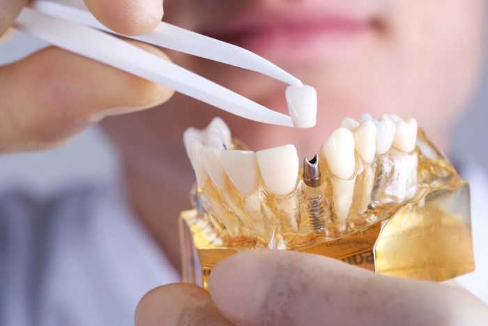 Dental Bridge: 4 Types, Benefits, Use Case and Costs