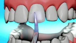 What Are Alternatives to a Root Canal?