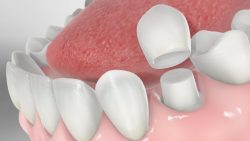How Is a Dental Crown Done | Temporary Crown vs Permanent Crown