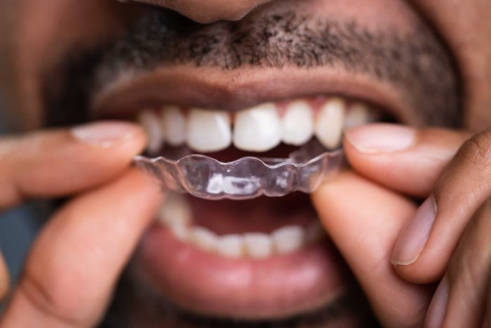 How to Find an Invisalign Dentist Near Me?