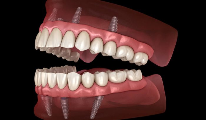 How Long Does It Take To Recover From Dental Implant Surgery?