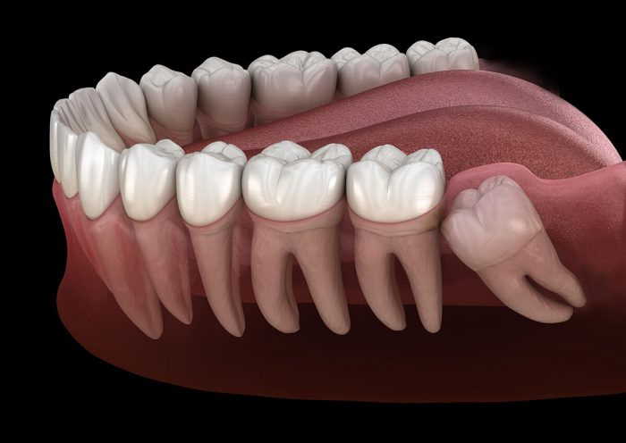 Impacted Wisdom Teeth Extraction Near Me | Extract Wisdom Teeth