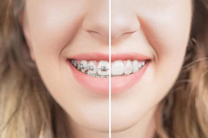 teeth before and after braces