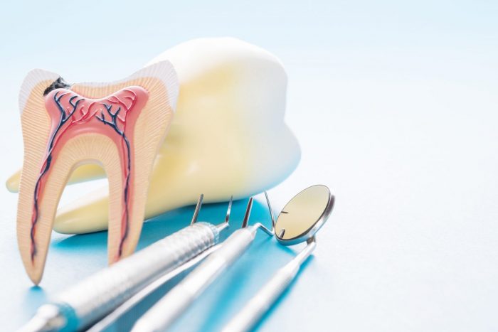 What Is The Best Alternative To A Root Canal?