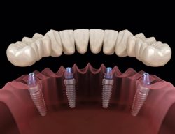 Dental Implants Procedure & Recovery