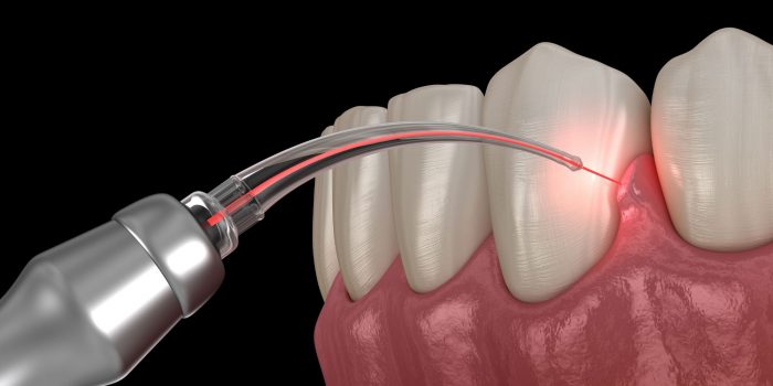 Laser Gingivectomy Near Me