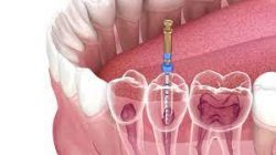 Signs Of Infection After Root Canal Treatment | Root Canal Infection Spread