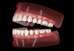 Dental Bridge Near Me | Maryland Bridge Dental | crowns on front teeth before and after