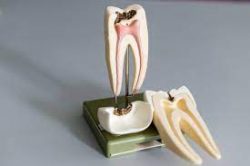 Root Canal Specialist Near Me | Root Canal Treatment Houston TX