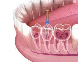 Root Canal Specialist | Root Canal Treatment