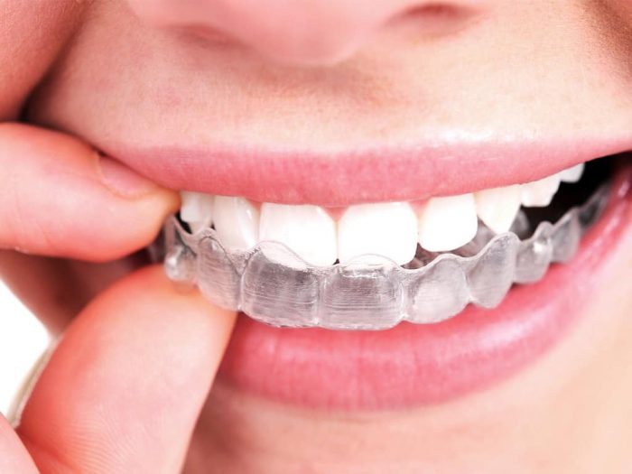 Invisalign Treatment in Houston, TX