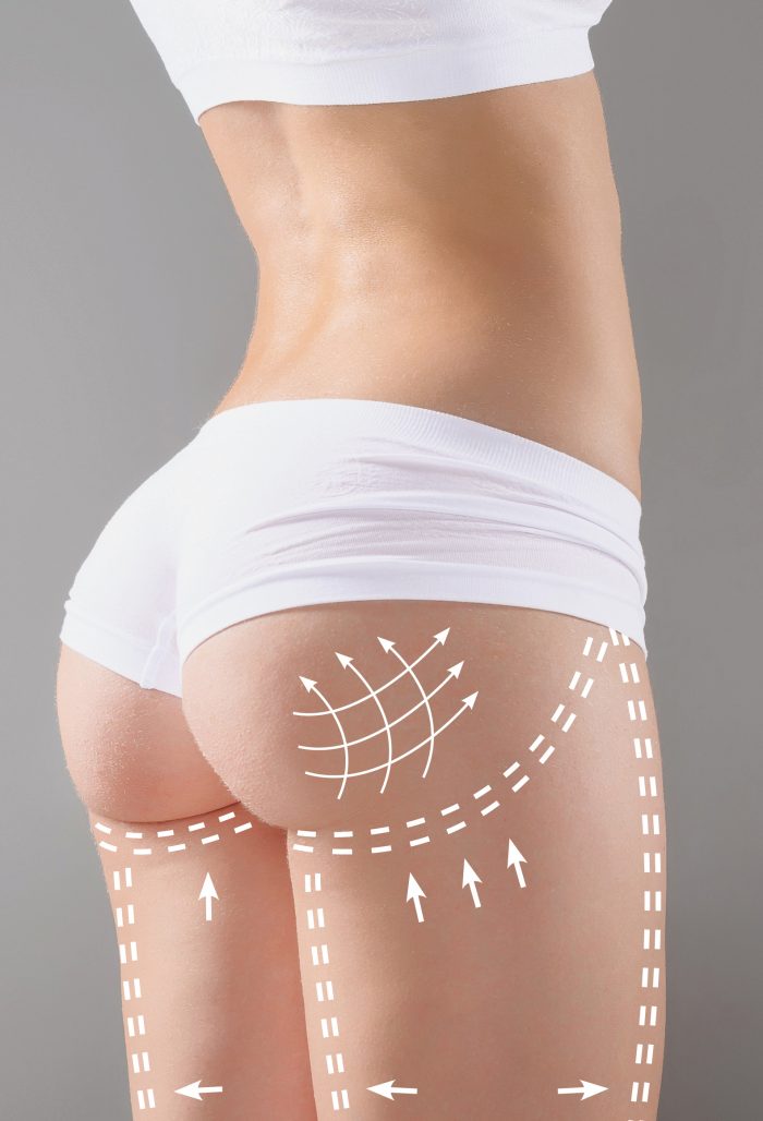 Brazilian Butt Lift: What to Expect, Surgery, Recovery & Risks