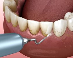 Periodontal Laser Surgery For Gum Disease
