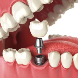 Single Tooth Implant Replacement | Single tooth implants: Pretreatment considerations