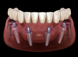 All On 4 Dental Implants Houston TX | | Omega Dental Houston TX