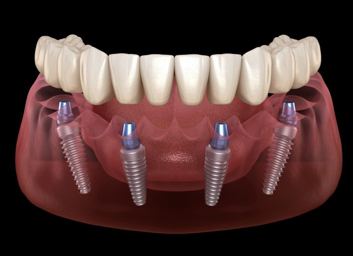 All On 4 Dental Implants Houston TX | | Omega Dental Houston TX