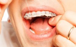Should You Get Braces Before Implants | Orthodontistbrace