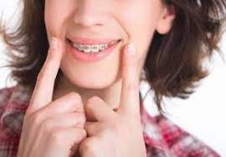 Should You Get Braces Before Implants