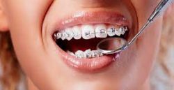 Local Orthodontist Near Me | Orthodontistbrace