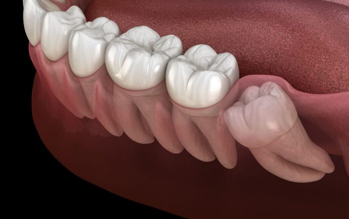 Emergency Wisdom Tooth Removal