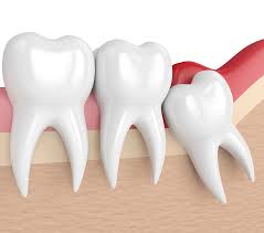 Emergency Wisdom Tooth Removal: What You Need to Know
