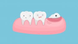 Wisdom Tooth Extraction | Wisdom Teeth Removal Houston | Emergency Wisdom Tooth Removal Near Me |