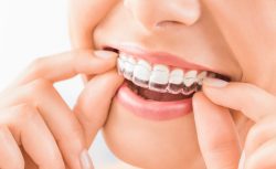 Invisible Teeth Braces for Adults | Braces for adults | Invisalign clear aligners