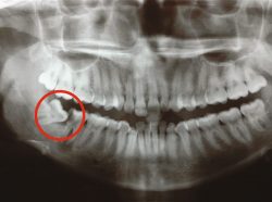 Impacted wisdom tooth | Infected Wisdom Tooth Symptoms