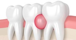 Symptoms of Tooth Infection
