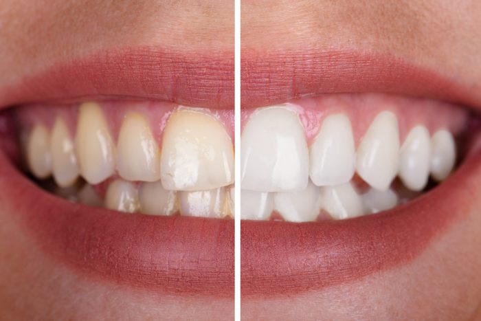 Teeth Bleaching Service Near Me | Teeth Bleaching Dentist in Houston TX