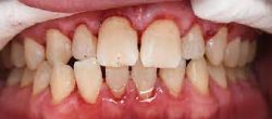 Dental Deep Cleaning for Gum Disease Treatment in Houston