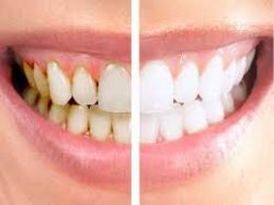 Gum Regeneration Treatment | Gum Recession: Causes, Prevention, Surgery & Treatment