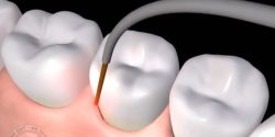 Laser Dentistry Near Me In Houston | Cosmetic Dentistry in Houston TX